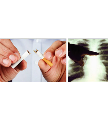 Buy Smokers Health Screening (SHS)  Online