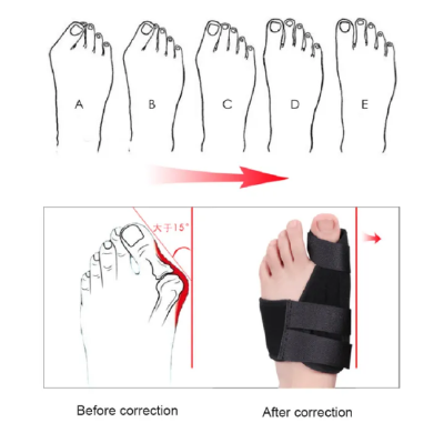 Picture of 1pcs Soft Bunion Corrector Toe Separator Splint Correction System Medical Device Hallux Valgus Foot Care Pedicure Orthotics - NF Surgical