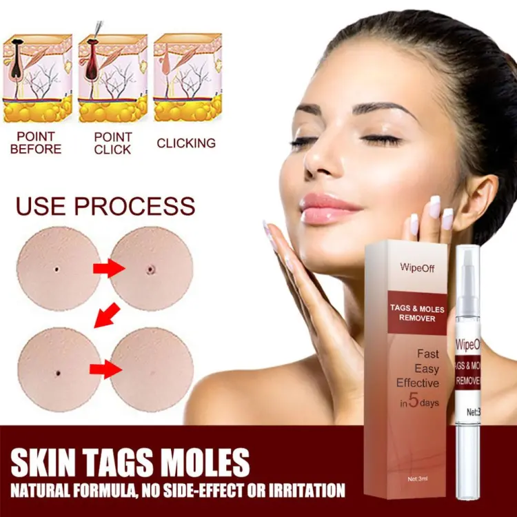 Buy "1pc Warts Remover Liquid Skin Tag Remover Skin Tag Herbal Treatment Wart Antibacterial Cream Remover Ointment Pen Liquid"  Online in Bangladesh