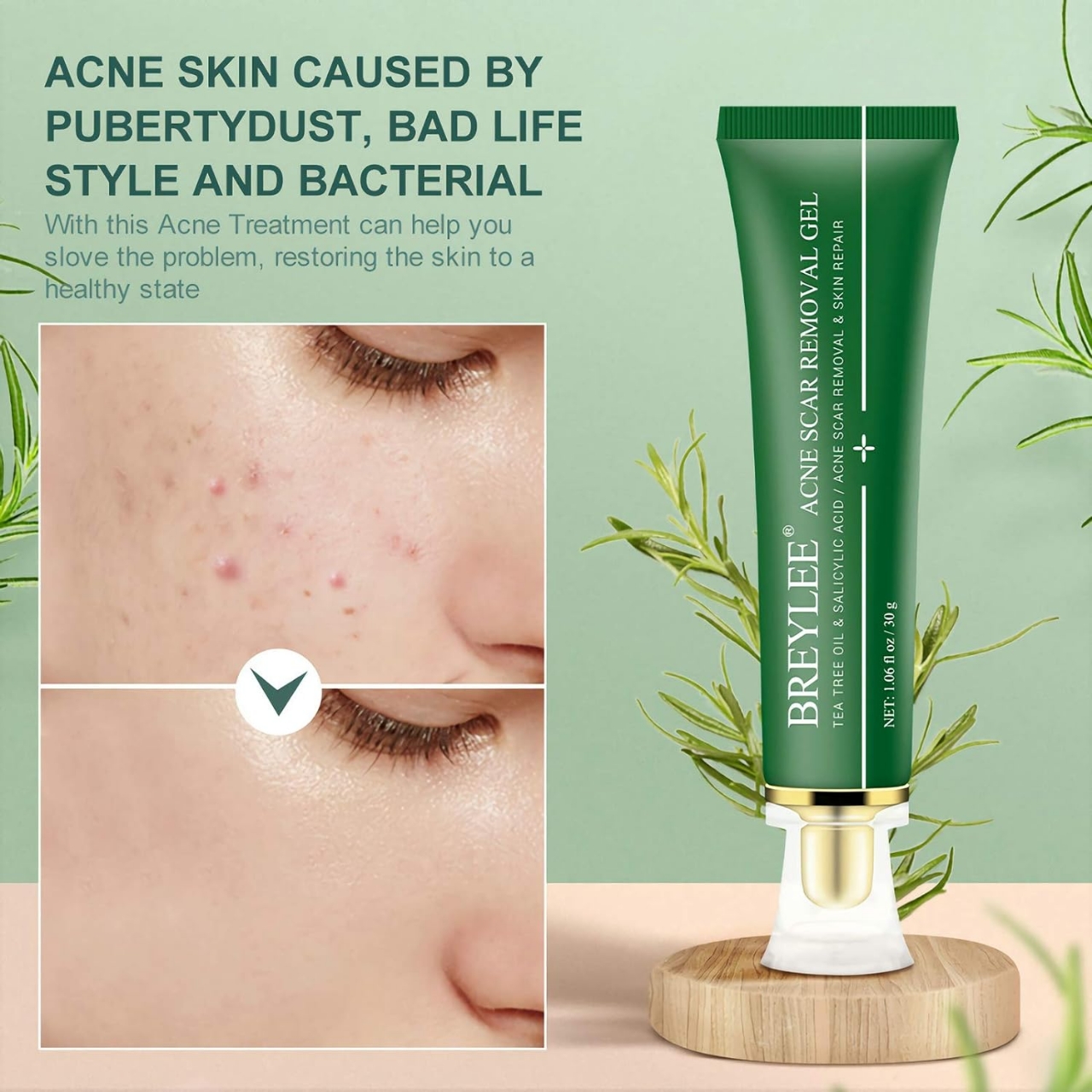 Picture of Breylee Acne & Scar Removal Gel 30g