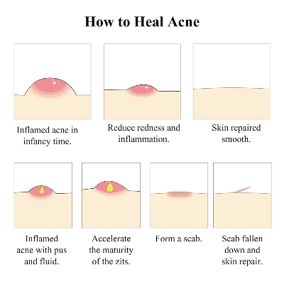 Picture of BREYLEE Acne Treatment Serum 17ml