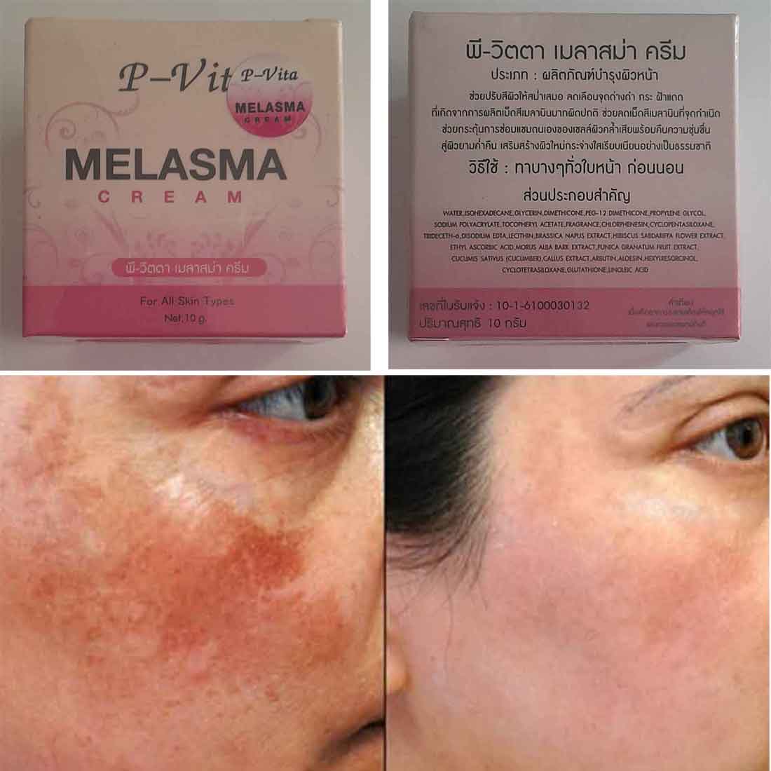 Buy P-Vita Melasma Cream 10gm at Best Price In Bangladesh