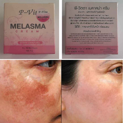 Buy P-Vita Melasma Cream 10gm at Best Price In Bangladesh