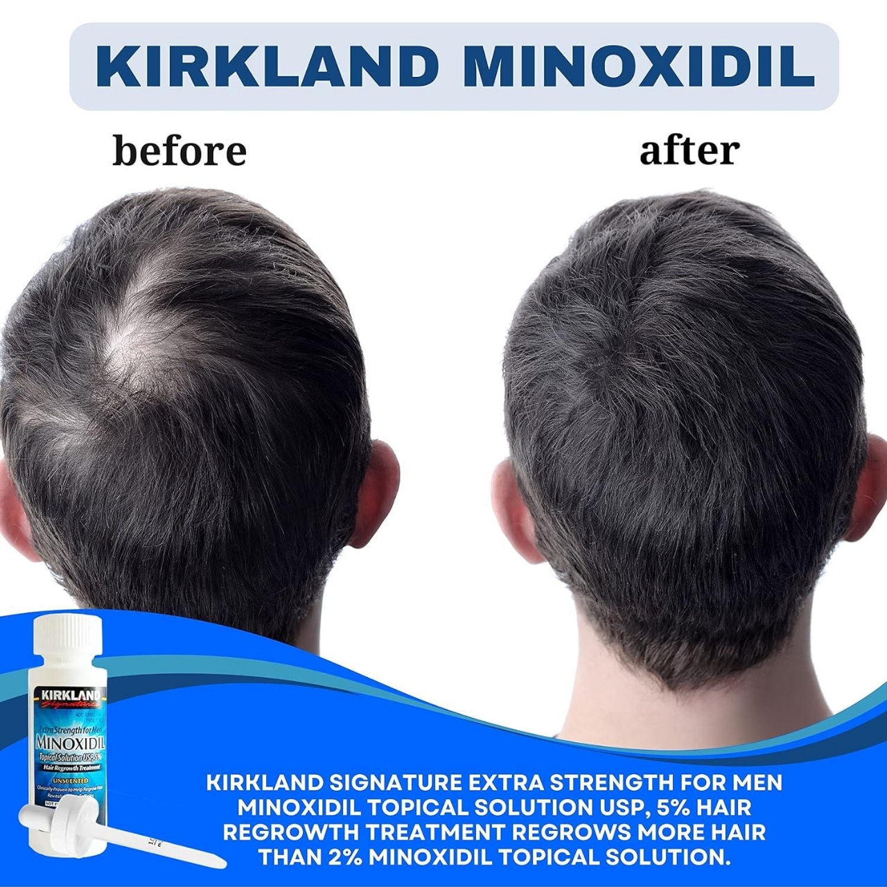 Picture of Kirkland Minoxidil 5% Topical Solution 60ml Extra Strength Hair Regrowth Treatment for Men Dropper Applicator Included