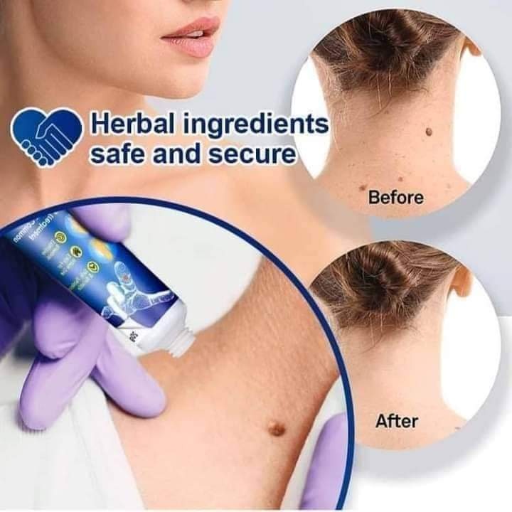 Picture of Wart Remover Ointment Essence -20g