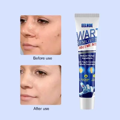 Picture of Warts & Skin Tag Remover Ointment: Treatment Cream