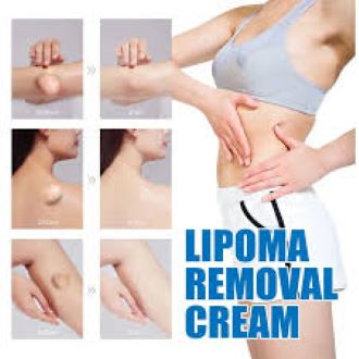 Picture of South Moon Lipoma Removal Cream Lipolysis Fat Lump Relieve Plaster Skin Swelling Ointment Subcutaneous Lumps Dredge Dissipate Body Care（20g）