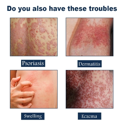 Picture of South Moon Psoriasis Relief Spray Net: 30ml