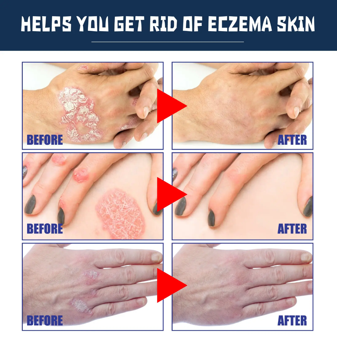 Picture of South Moon Psoriasis Relief Spray Net: 30ml