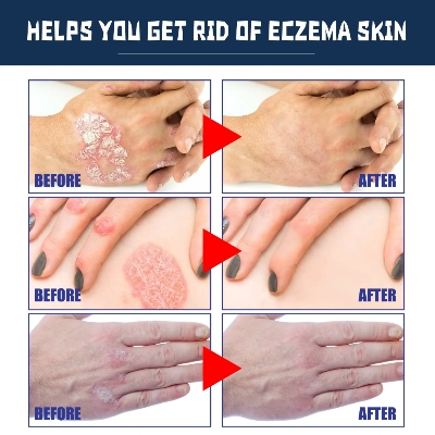 Picture of South Moon Psoriasis Relief Spray Net: 30ml