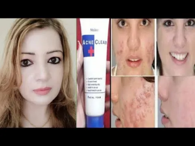 Buy MISTINE ACNE CLEAR FACIAL FOAM 85G. Face Wash (Made In Thailand) at best price in bangladesh