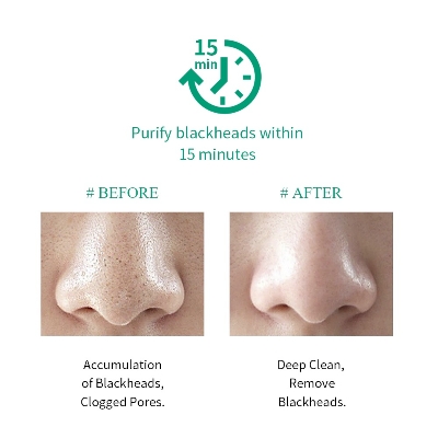 Picture of Breylee Tea Tree Blackhead Mask Step -1