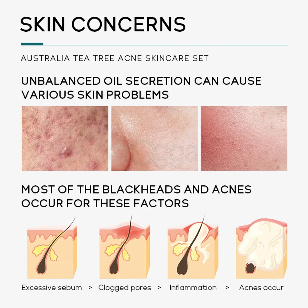 Picture of LAIKOU Remove Acne Australia Tea Tree Skin Care Set (Cleanser, Toner, Serum, Gel & Cream)