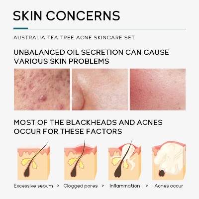 Picture of LAIKOU Remove Acne Australia Tea Tree Skin Care Set (Cleanser, Toner, Serum, Gel & Cream)