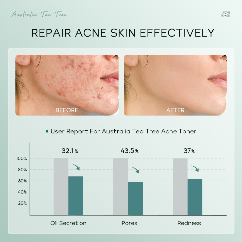 Picture of LAIKOU Acne Care Australia Tea Tree Acne Toner- 100ml