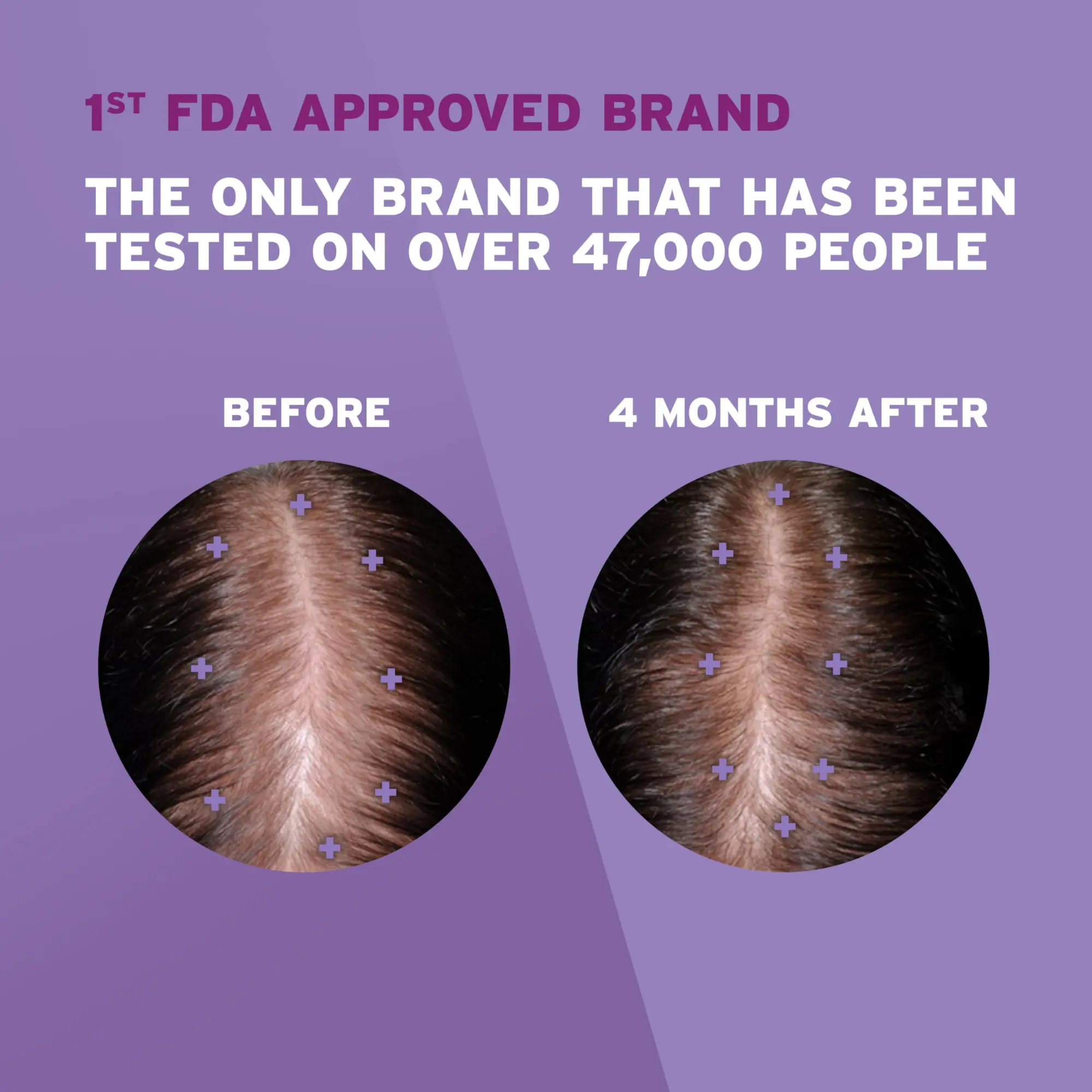 Picture of Female Minoxidil Rogaine Topical Solution Hair Regrowth Treatment 2% Minoxidil for Women - 60 ml 30 Days Supply with Derma Roller Combo