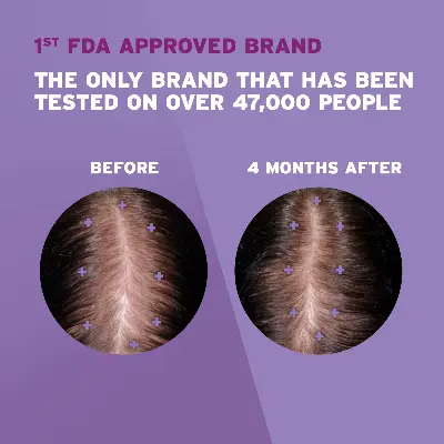 Picture of Female Minoxidil Rogaine Topical Solution Hair Regrowth Treatment 2% Minoxidil for Women - 60 ml 30 Days Supply with Derma Roller Combo