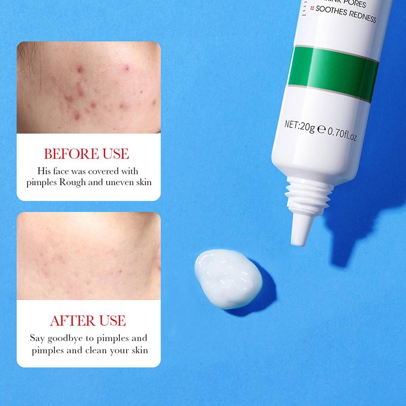 Picture of BIOAQUA Salicylic Acid Face Cream Acne Creams Mark Repair skin Facial Cream 20g
