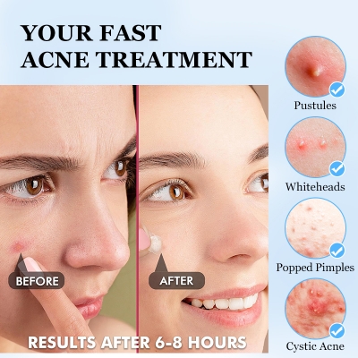 Picture of Hydrocolloid Top Pimple Patch Box Top Acne Treatment Face and body