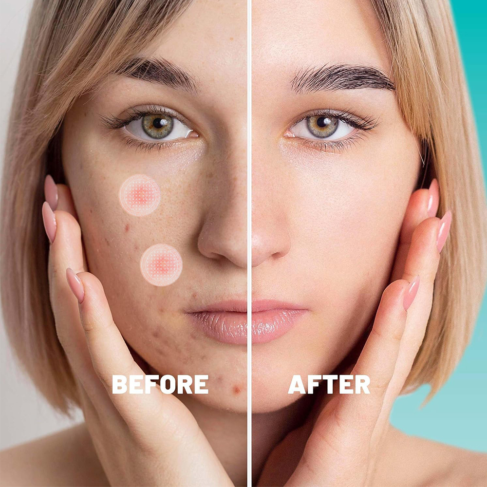 Picture of Hydrocolloid Top Pimple Patch Box Top Acne Treatment Face and body