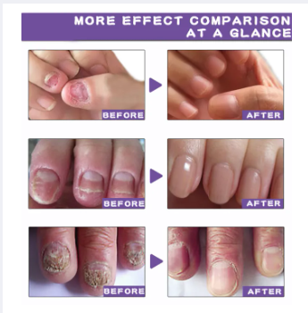 Picture of ELHOE Makes Your Nail Clean ELHOE Nail Repair Serum Nail Repair Oil 15ML