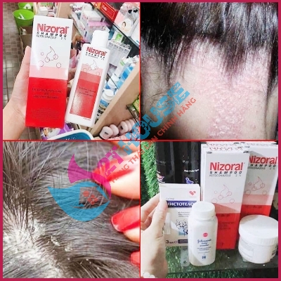 Picture of Nizoral 2% Ketoconazole Hair Care Anti-Dandruff Shampoo 50ml