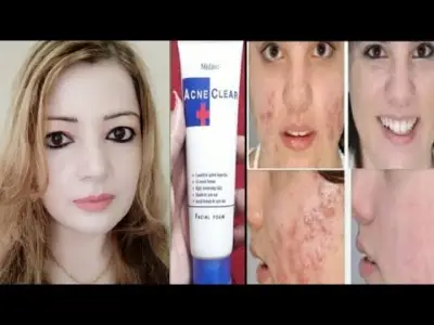 Picture of MISTINE ACNE CLEAR FACIAL FOAM 85G. Face Wash (Made In Thailand)