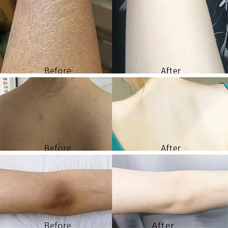 Picture of LANBENA Skin Face and Underarm Whitening serum for men and women Retinol EELHOE Face Serum