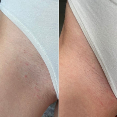 Picture of Intimify Serum Makes Your Underarm And Bikini Areas Cleaning And Hygiene Intimate Area Cleaner