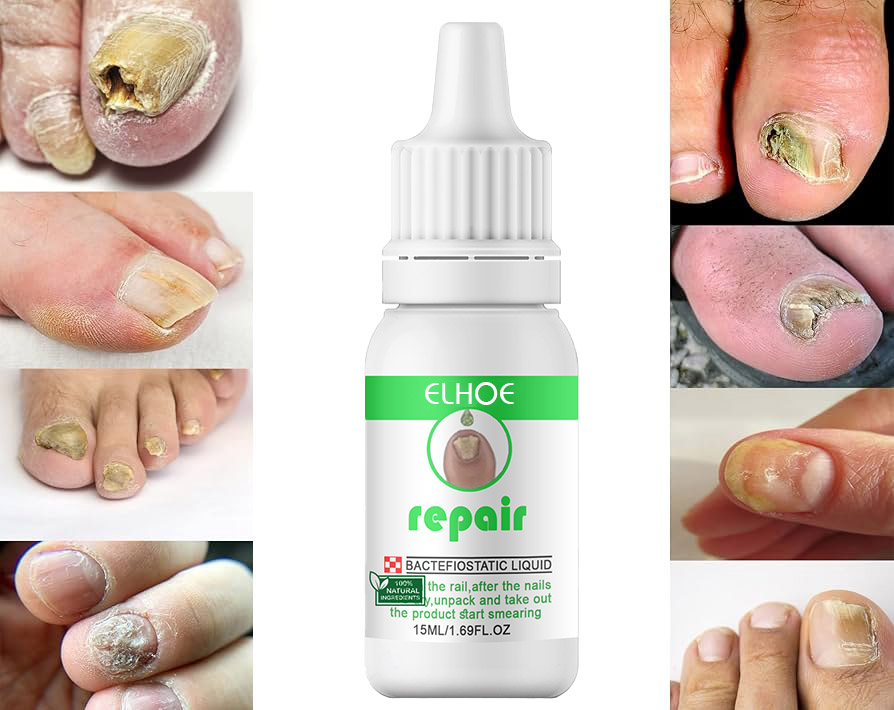 Picture of Repair Nail Fungus Treatment Serum Toe Fungal Repair Products Hand Foot Care Removal Gel Anti Infection Onychomycosis Paronychia