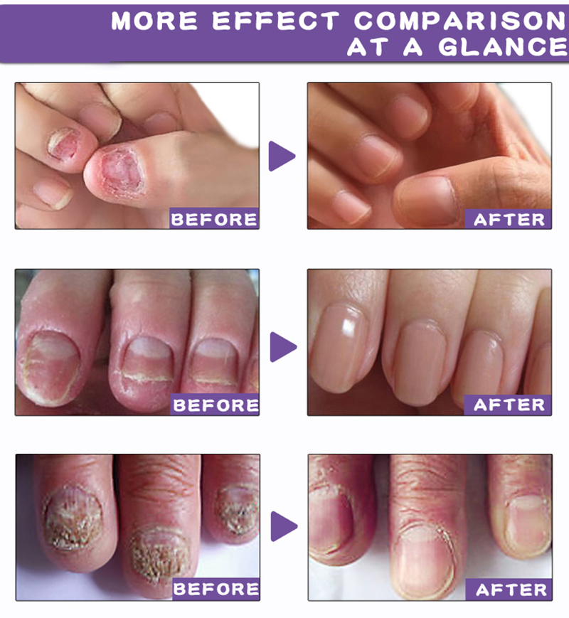 Picture of Repair Nail Fungus Treatment Serum Toe Fungal Repair Products Hand Foot Care Removal Gel Anti Infection Onychomycosis Paronychia
