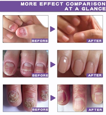 Picture of Repair Nail Fungus Treatment Serum Toe Fungal Repair Products Hand Foot Care Removal Gel Anti Infection Onychomycosis Paronychia