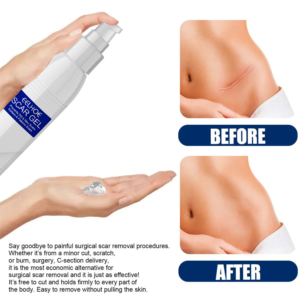 Picture of EELHOE Scar Removal Cream Gel Burn Surgical Scar Cesarean Scar Repairing Stretch Marks Pigmentation Corrector
