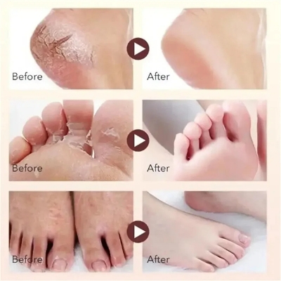 Picture of EELHOE Anti Crack Foot Hand Gel Ginger  Cuticles Care Anti-Drying Healing Crack Frost Mask Dead Skin Removal Deep Moisturizing Feet Crack Whitening Smooth Feet Care