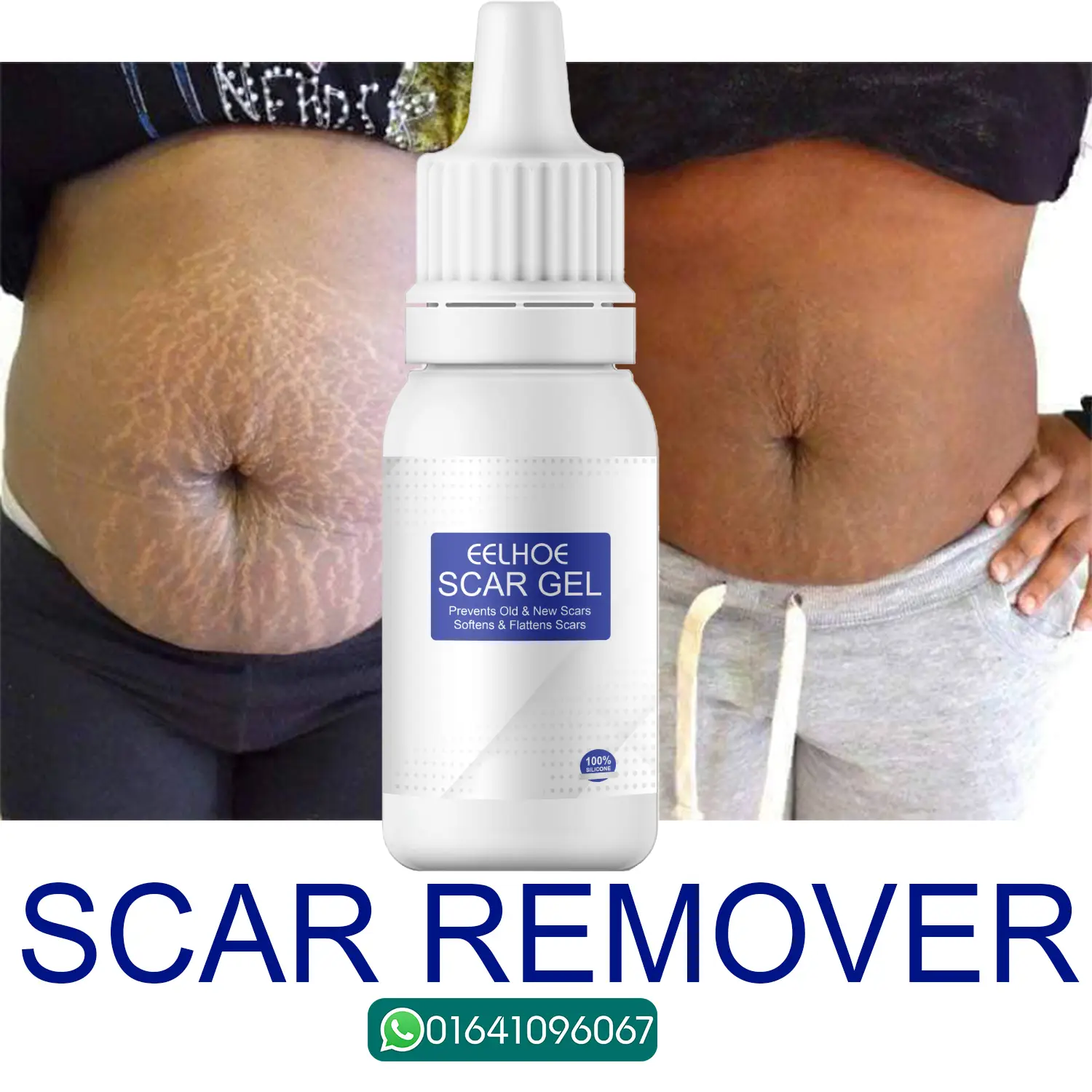 Picture of EELHOE Scar Removal Cream Gel Burn Surgical Scar Cesarean Scar Repairing Stretch Marks Pigmentation Corrector