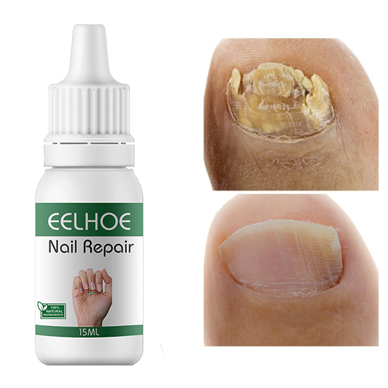 Picture of EELHOE Makes Your Nail Clean EELHOE Nail Repair Serum Nail Repair Oil 15ML