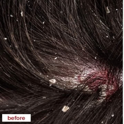 Picture of Nizoral 2% Ketoconazole Hair Care Anti-Dandruff Shampoo 50ml