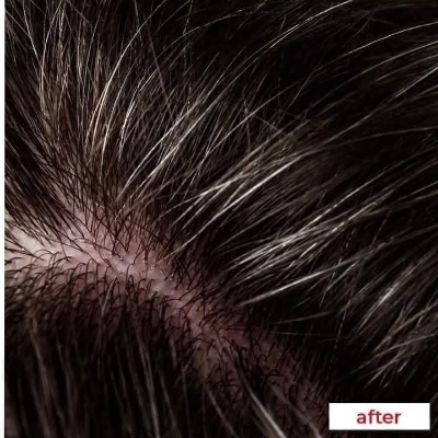 Picture of Nizoral 2% Ketoconazole Hair Care Anti-Dandruff Shampoo 100ml