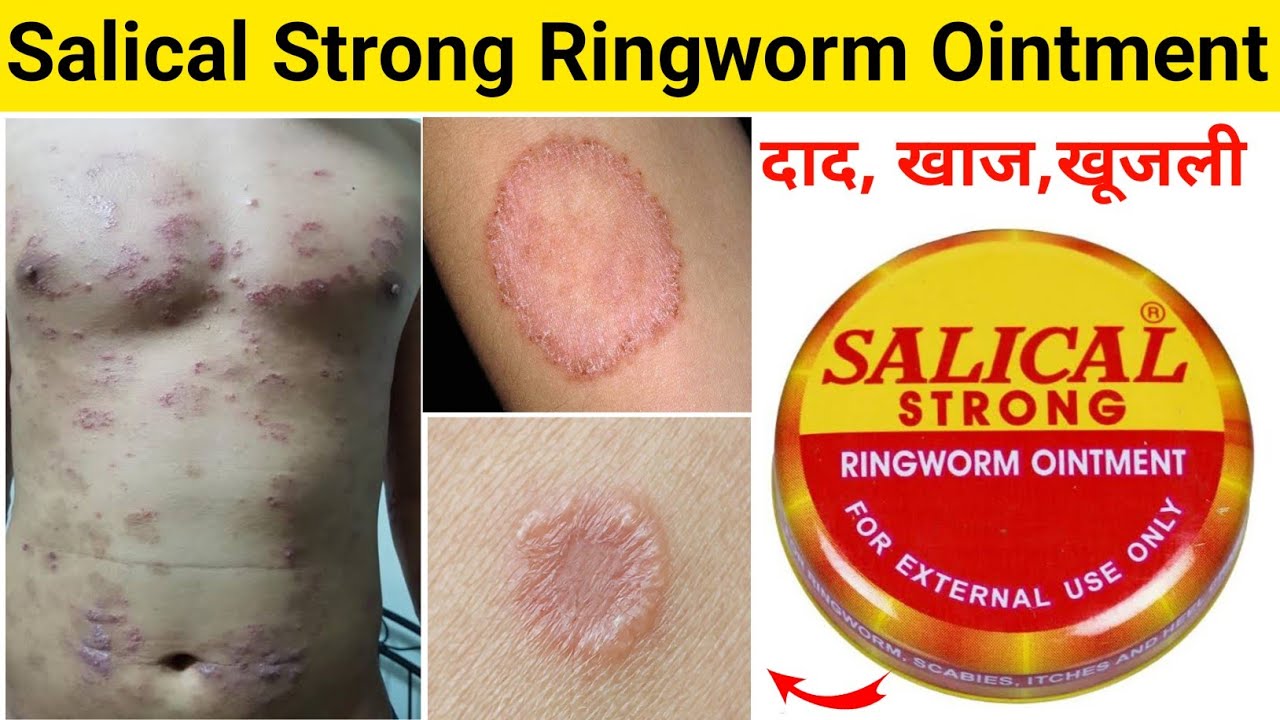 Picture of SALICAL STRONG Ointment 15g