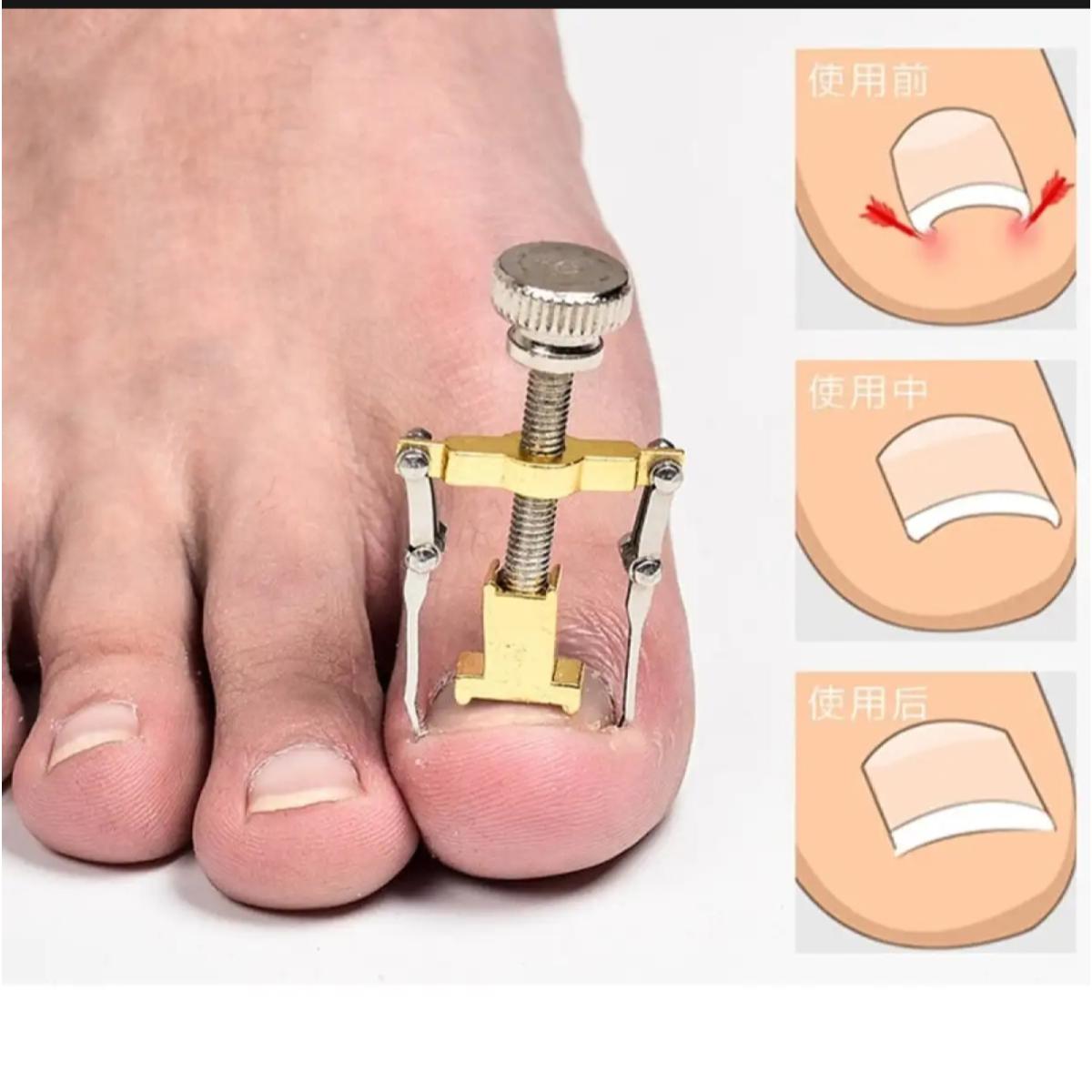 Picture of Professional Ingrown Toe Nail Recover Correction Fixer Manicure Pedicure Nails Care Tool