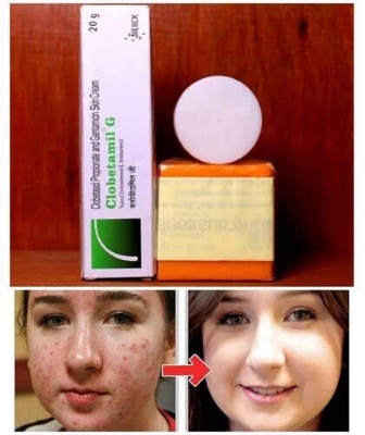 Picture of Clobetamil G Skin Soap and Cream Set