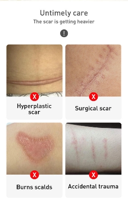 Picture of TCM -scar and acne mark removal gel ointment-30gm