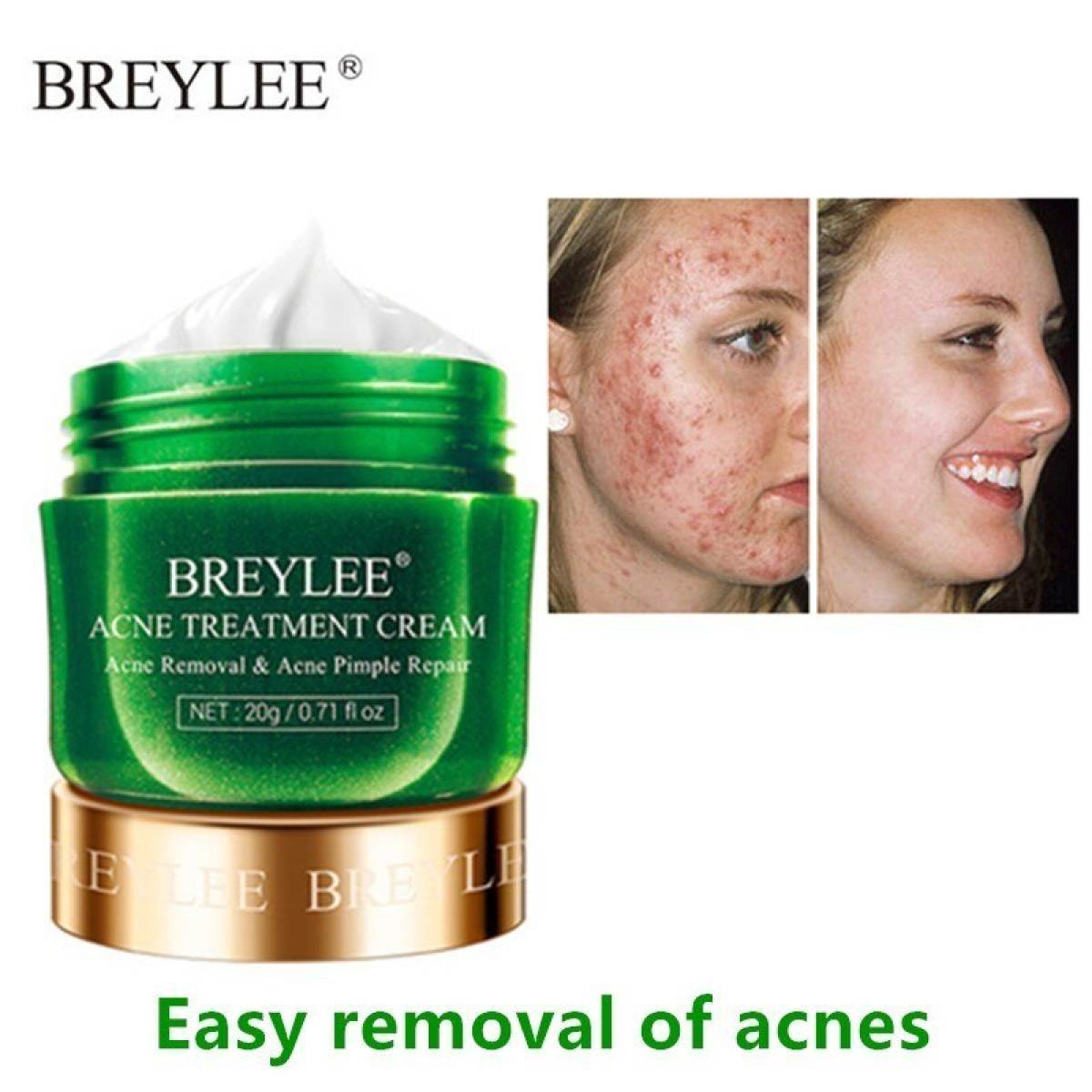 Picture of BREYLEE Acne Treatment Cream and Serum( 20g +17ml)-Acne Combo