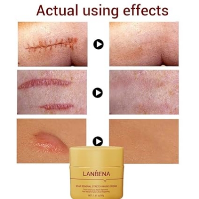 Picture of LANBENA Scar Remover Cream Repair Serum Stretch Mark Blackhead Acne Spots TCM Removal Gel Whitening Face Body Essence-40GM