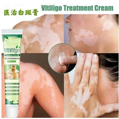 Picture of Sumifun Vitiligo Cream Reduces White Spots and Improves Skin Pigmentation-20gm