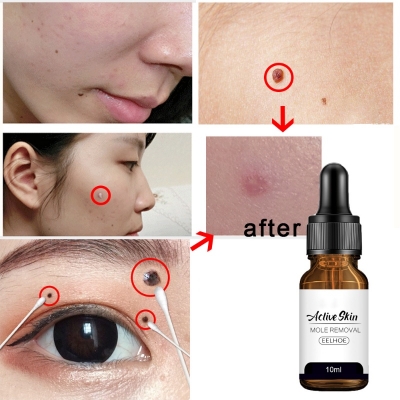 Picture of Eelhoe Active Skin Mole Reduce Serum Spot Removing Essence Face Mole Removal Repair Barrier Fix Facial Blemish Smooth Skin-10ml
