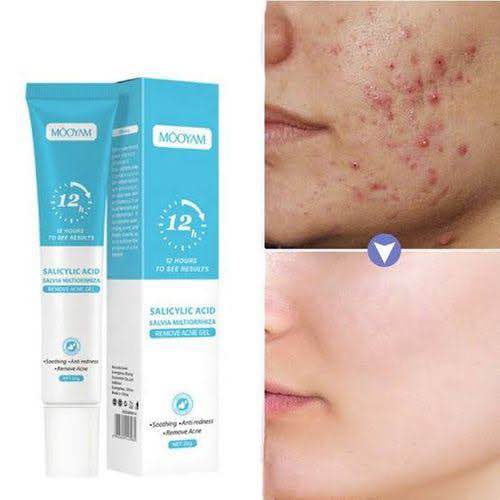Picture of MOOYAM Salicylic Acid Remove Acne Gel For Stubborn Acne Pimple Breakouts-20gm