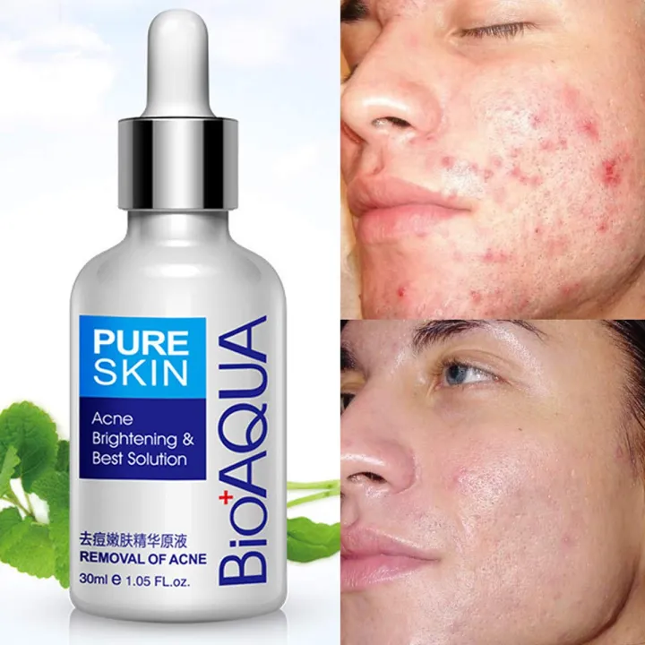 Picture of Bioaqua Anti-Acne Serum Removal Of Acne Essence Liquid 30ML