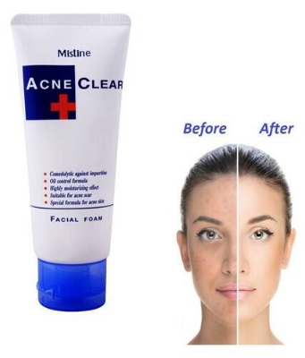 Picture of Mistine Acne Scar Clear Oil Blemish Control Facial Foam Face Wash From (Thailand)85 g