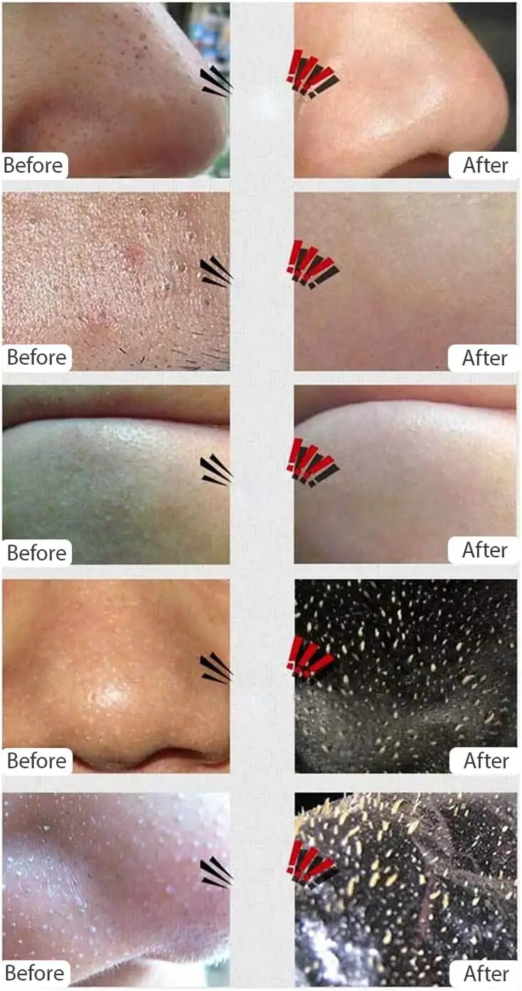 Picture of AICHUN BEAUTY Whitening Complex Black Mask Remove Blackhead Deep Cleansing Pilaten Blackhead Remover Purifying Peel Face Mask 120ml